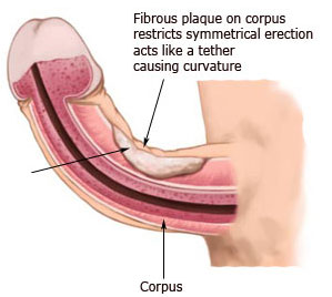 abnormal-curvature-peyronies-disease